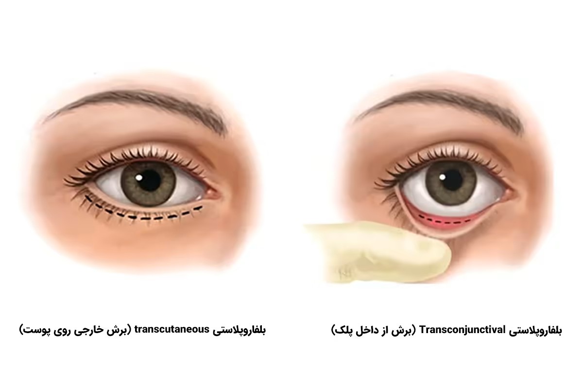 جراحی پلک افتاده