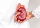 مشکلات کلیوی ناشی از مصرف پروتئین حیوانی: مروری جامع